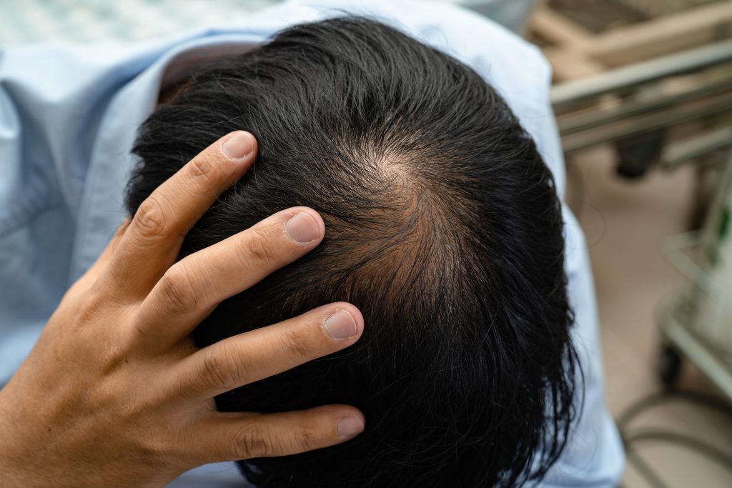 What You Should Do To Avoid Hair Loss! Featured Image 0001251